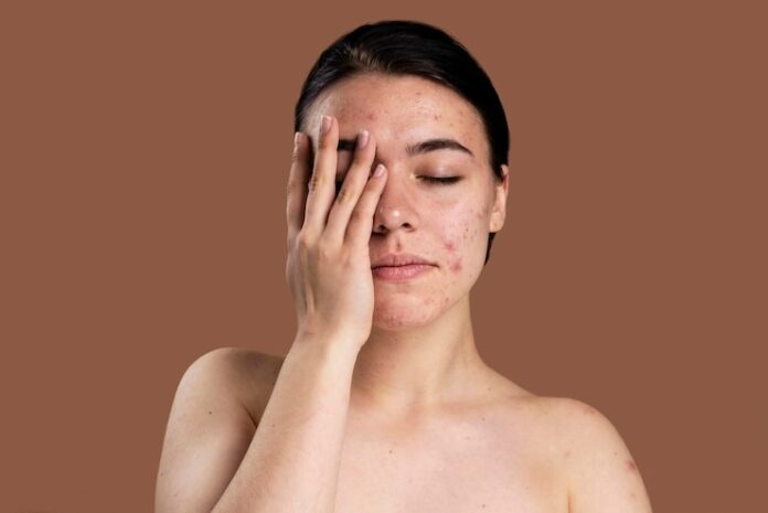 Skin Changes: Acne, Dryness, or Unusual Hair Growth