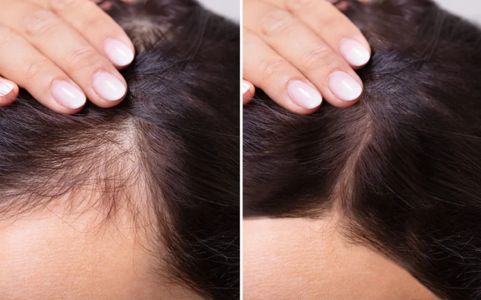 Preventing hair thinning