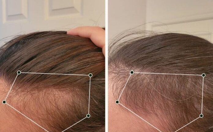 Strengthening Follicles from Within