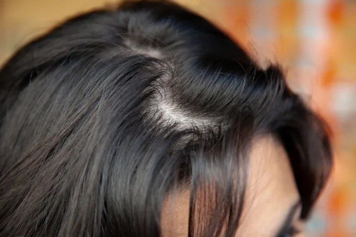 Why Hair Starts Thinning